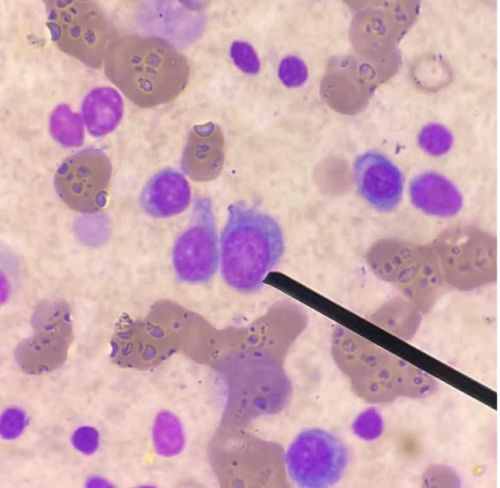<p>A. Identify the cell (Normoblastic / Rubriblastic / Erythroblastic)</p><p>B. Striking feature </p><p>C. Describe N:C ratio</p><p>D. Describe cytoplasm </p>