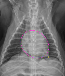 <p>-heart round to elongated</p><p>-apex VERY left of midline</p><p>-heart and cupula practically touching</p>