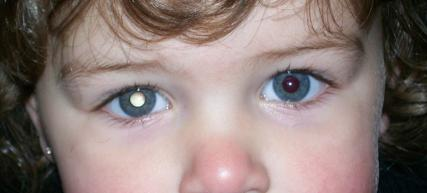 <p>What childhood cancer is this? </p>