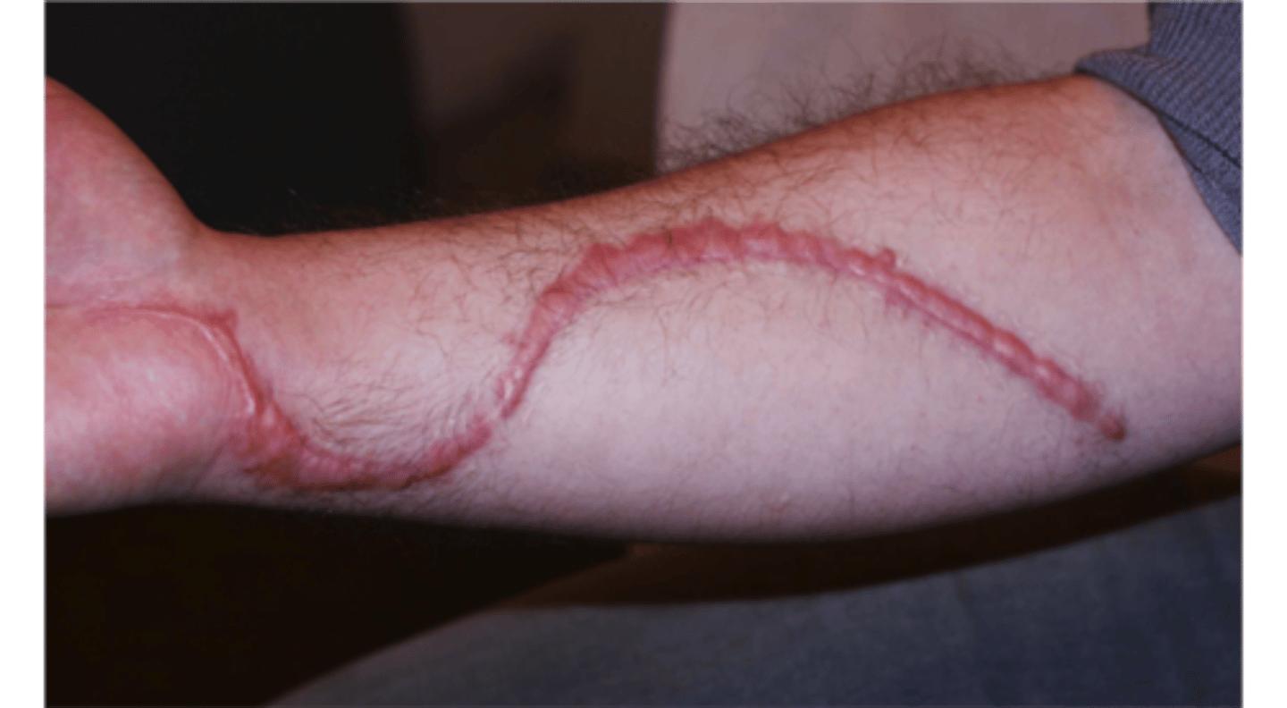 <p>n. a scar</p>