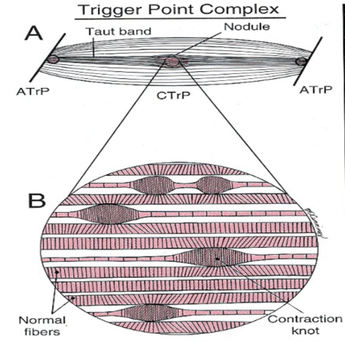 <p>Asymptomatic unless palpated</p>