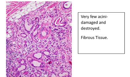 <p>Serous</p><p>Inflammation and fibrosis of glands → loss of function</p>