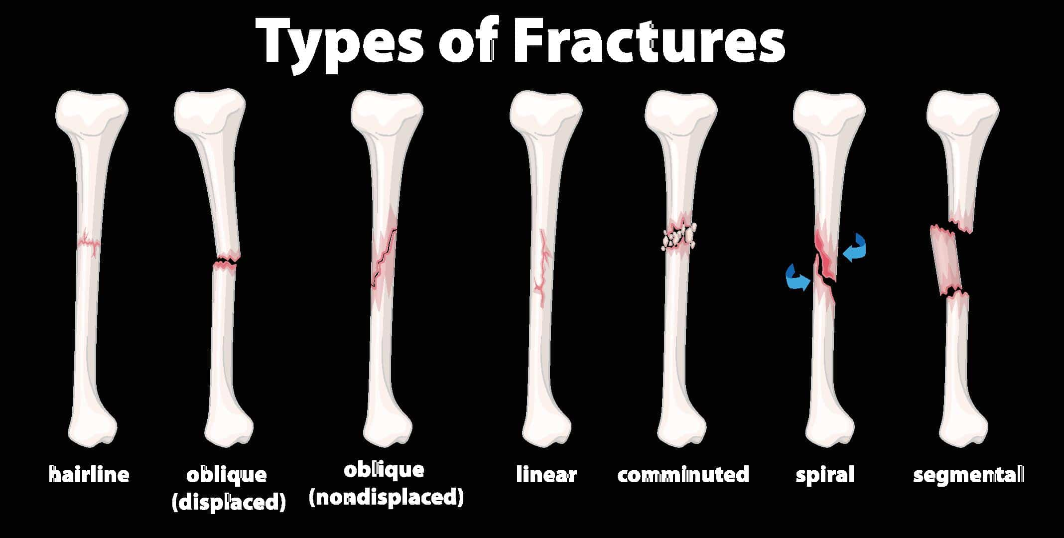 <p></p><ul><li><p>Open fracture: fracture with an associated open wound</p></li><li><p>Closed fracture: no break in the skin</p></li><li><p>Hairline fracture: small crack in the bone that does not create instability</p></li></ul>