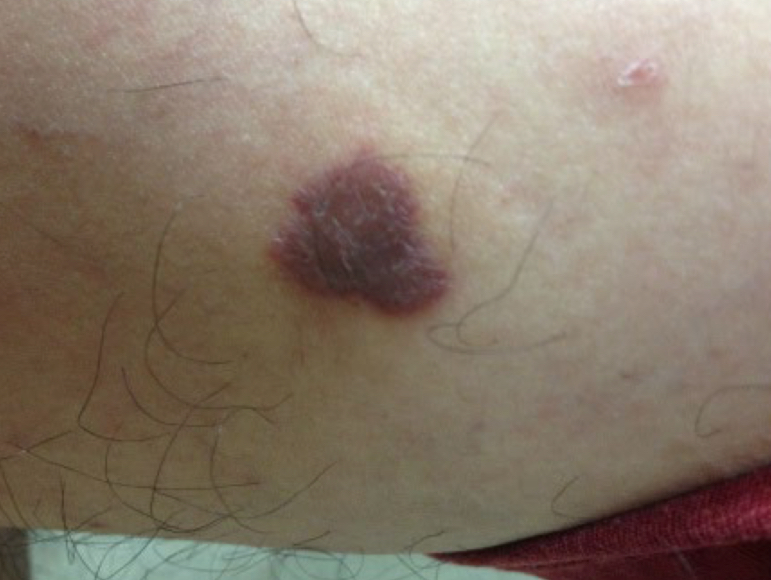 <p>what type of color change and condition is depicted</p>