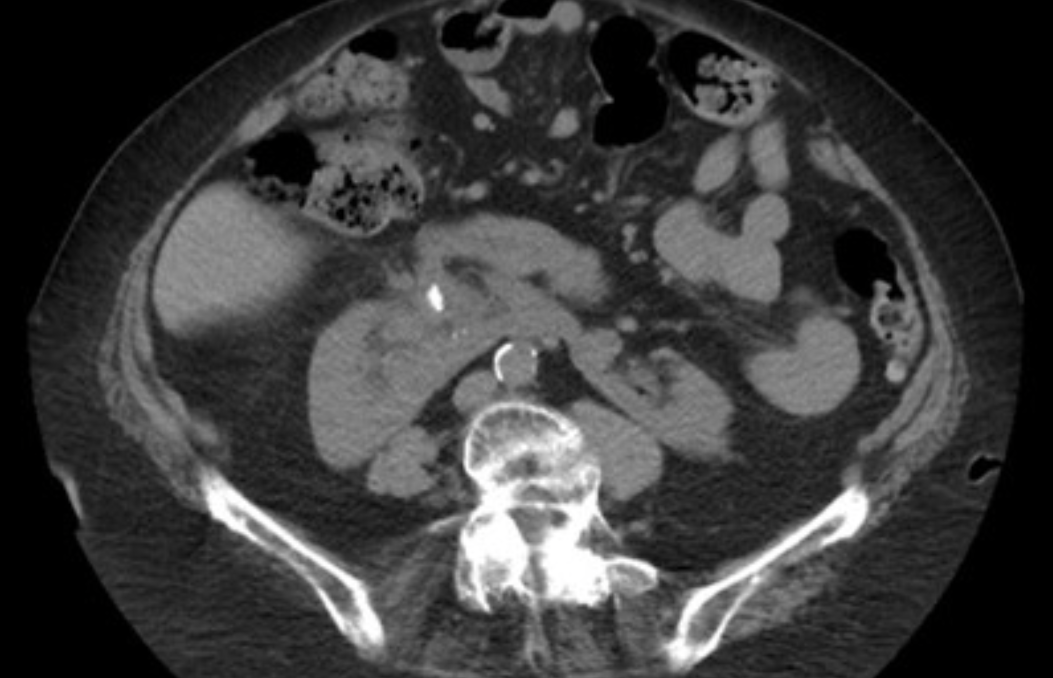 <p>What I this showing? What is <span>The safest method to maximize stone clearance when accessing this kidney 1.5 cm lower pole partial staghorn stone extending to the renal pelvis? </span></p>