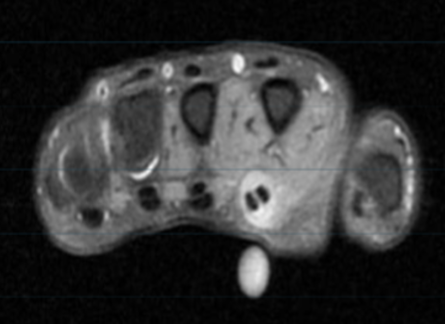 <p>Describe the pathology (Ax T2 FS). </p>