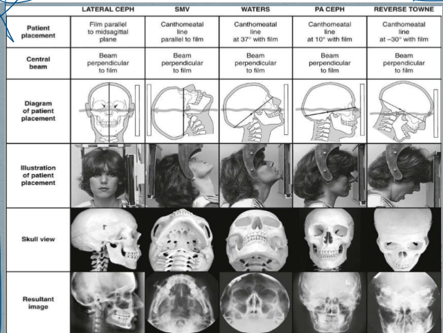 <p>to view max sinus (waters projection)</p>