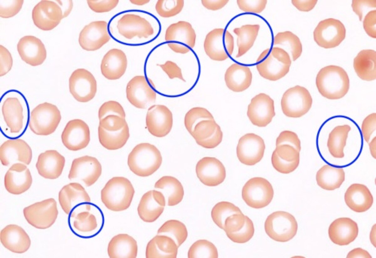 <p>Schistocyte</p>