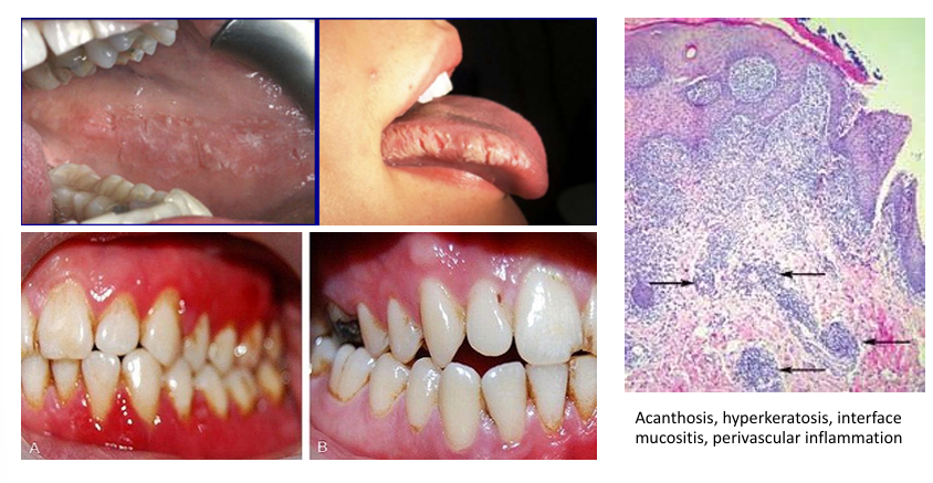 <p>-white lesion with erythematous base</p><p>-diffuse (toothpaste) or localized (gum/candy)</p><p>-common to have pain or burning</p><p>-gingiva = most common with toothpaste use, resembles plasma cell gingivitis</p><p>-buccal mucosa/lateral tongue = most common with gum/candy use, resembles morsicatio or OHL</p><p>-usually diagnosed based on clinical appearance and use of cinnamon products</p><p>-biopsy can be used to rule out autoimmune/neoplastic processes</p>