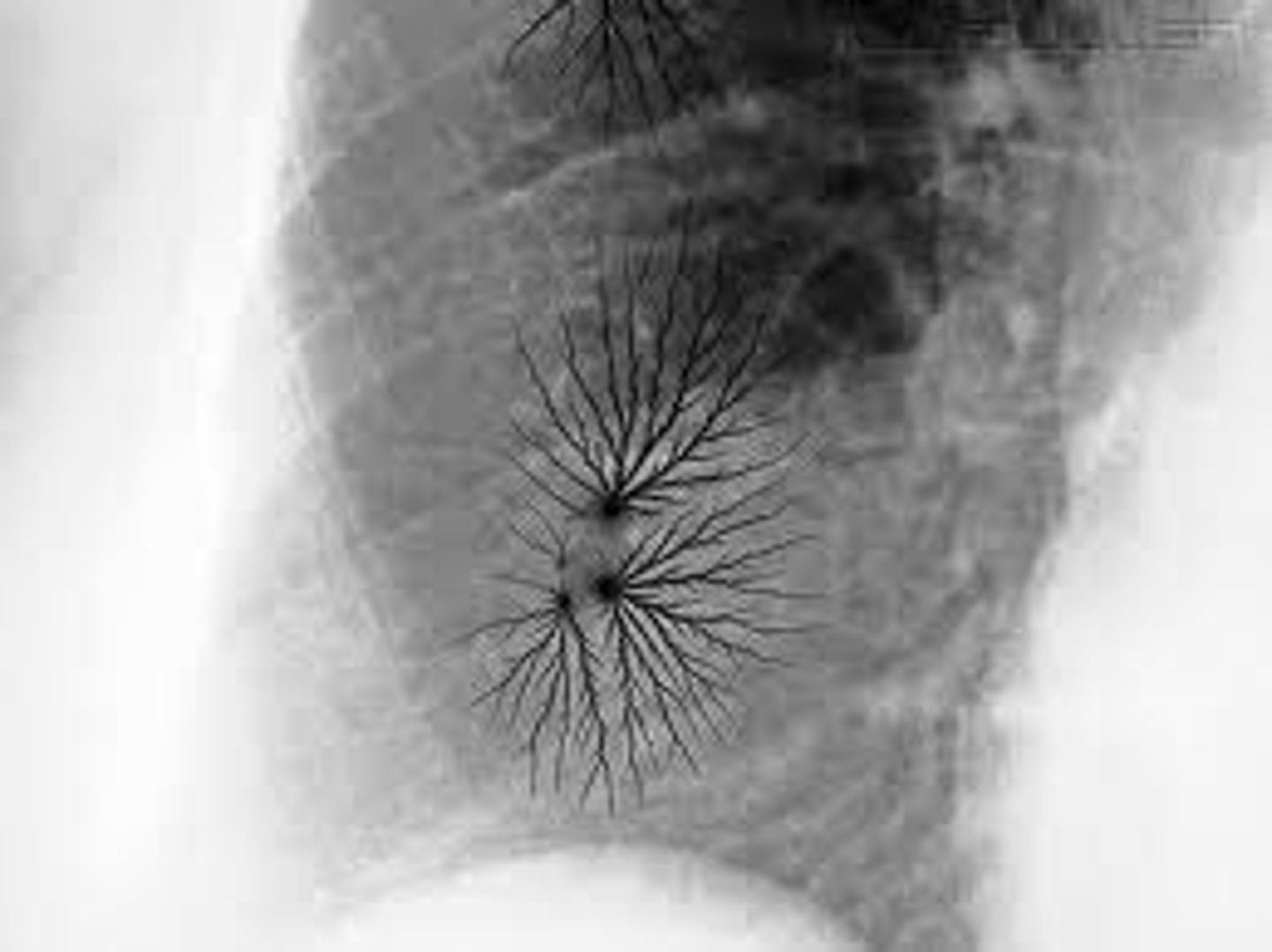 <p>What causes the Black Tree artifacts?</p>