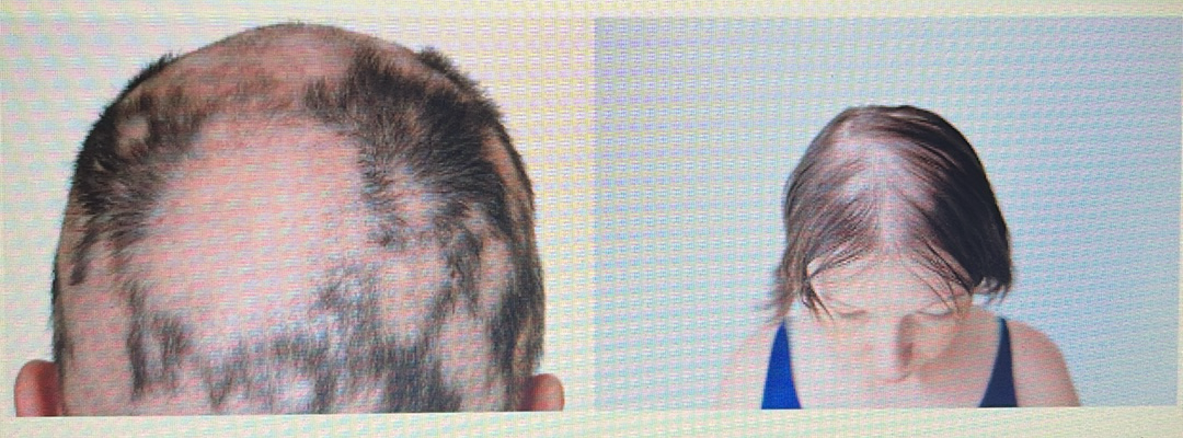 <p>HAIR DISORDER</p><p><span style="font-family: Calibri, sans-serif"><strong>Alopecia areata:</strong>&nbsp;Patches of hair loss caused by an autoimmune disease</span></p>