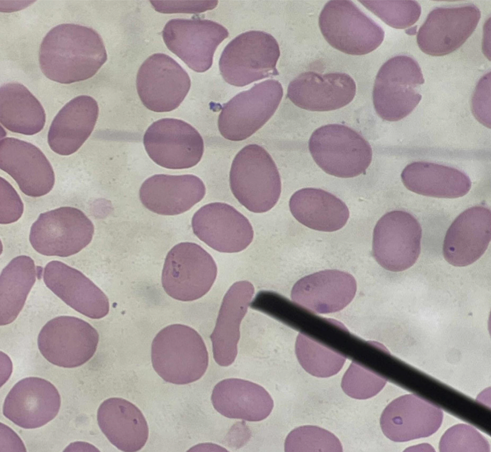 <p>A. Identify the pointed cell</p><p>B. Describe the striking feature</p><p>C. Associated with what condition ?</p><p>D. Main membrane defect? </p>