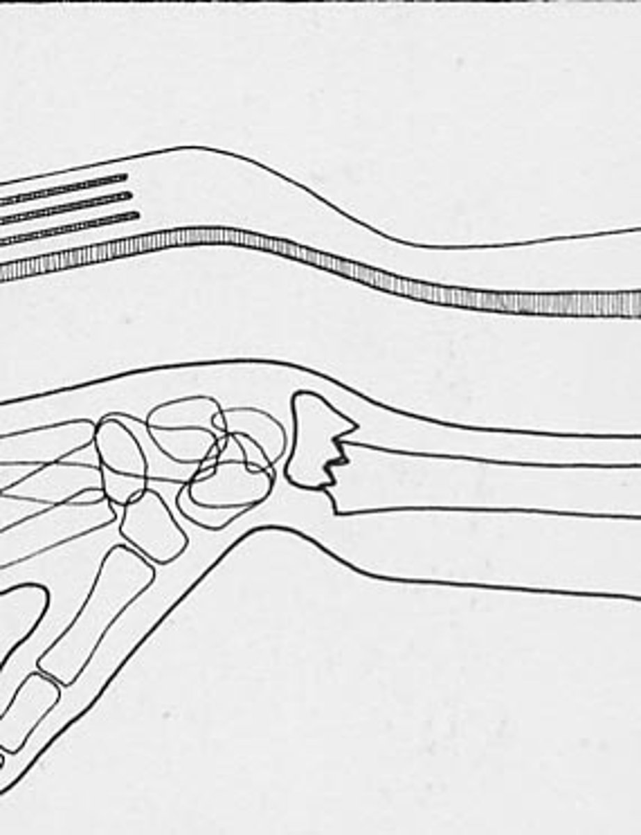 <p>dorsal displacement of distal fragment of radius with radial shift of wrist and hand results in dinner fork deformity</p>