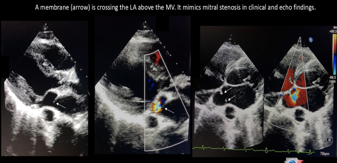 <p>Cor triatriatum of the LA can lead to which flow complication?</p>