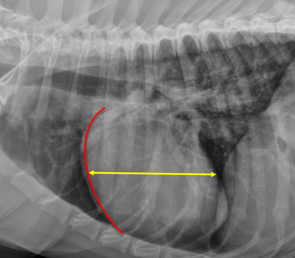 <p>-wide cardiac silhouette</p><p>-cr.margin super bowed out —> increased sternal contact</p>