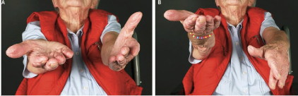 <ul><li><p>motor function test</p></li><li><p>patient can be seated or standing </p></li><li><p>have patient hold both arms forward, parallel to ground, palms up</p></li><li><p>have patient close their eyes and watch to see if arms drift</p></li><li><p>have patient keep their eyes closed while you tap the arms briskly downwards </p></li></ul><p></p>