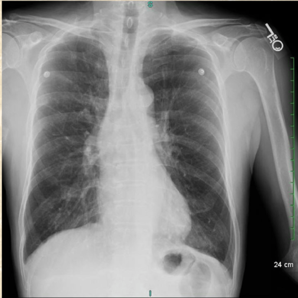 <p>What do you believe this patient is suffering from?</p><p>What CXR findings are typical in this patients Dx?</p>