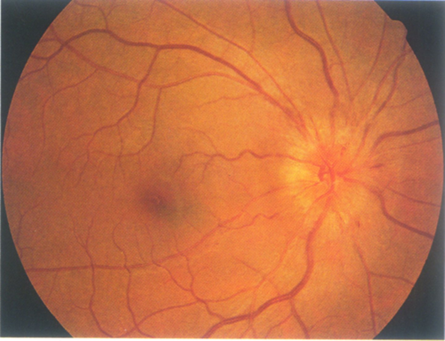<p>AAION causing disc edema, flame hemes</p>