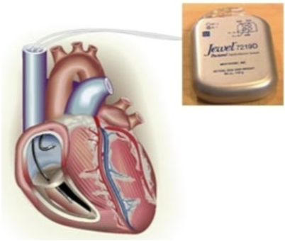 <ul><li><p>act as a pacemaker, defibrillator, and cardioverter</p></li><li><p>detect and prevent sudden cardiac arrest</p></li><li><p>device works by detecting a dangerous rapid heart beat and then delivering a shock to help restore a normal rhythm</p><ul><li><p>no more discomfort than being kicked in the chest</p></li></ul></li></ul><p></p>