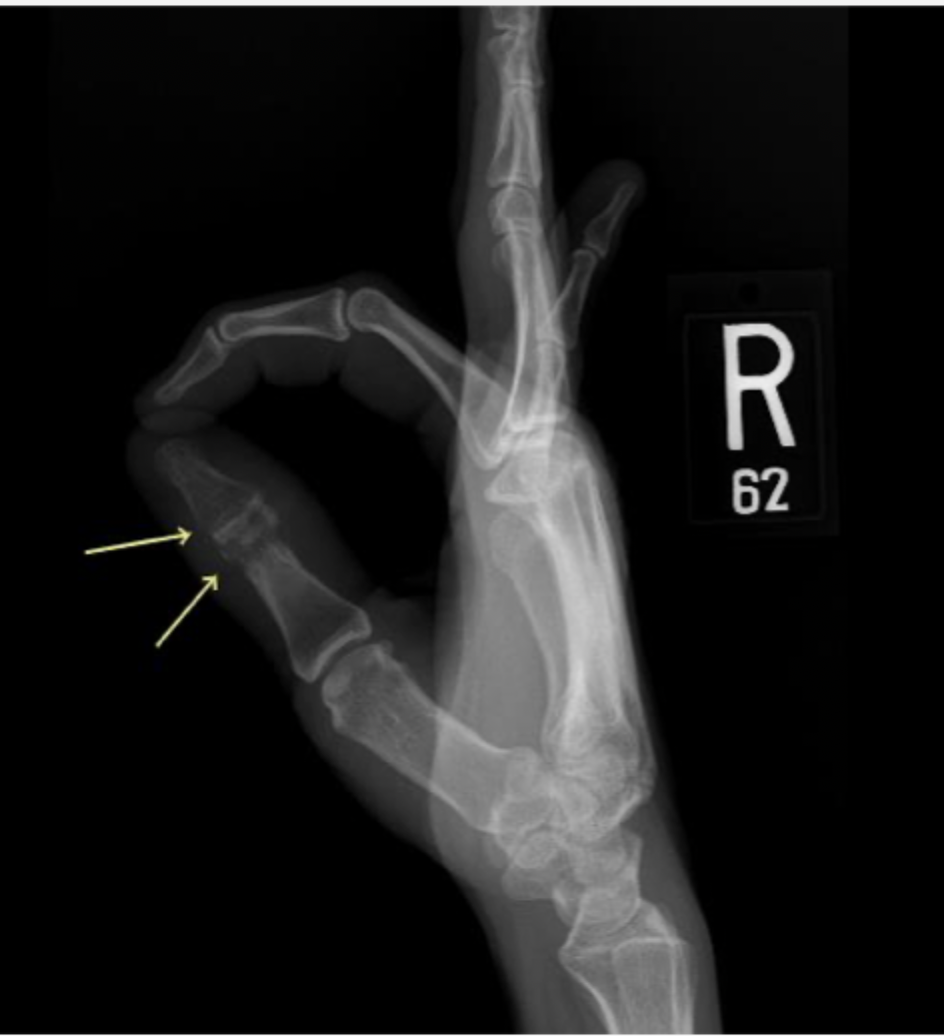 <p>45 y/o male presents to the ED with hand pain. On physical exam you note tenderness over the thumb that is red and swollen with a small open wound. Vitals are stable with an exception of a fever. Xrays show bone lucency, sclerosis, erosive changes, and periosteal reactions. MRI shows edema in T2 imaging.  What is your treatment plan?</p>