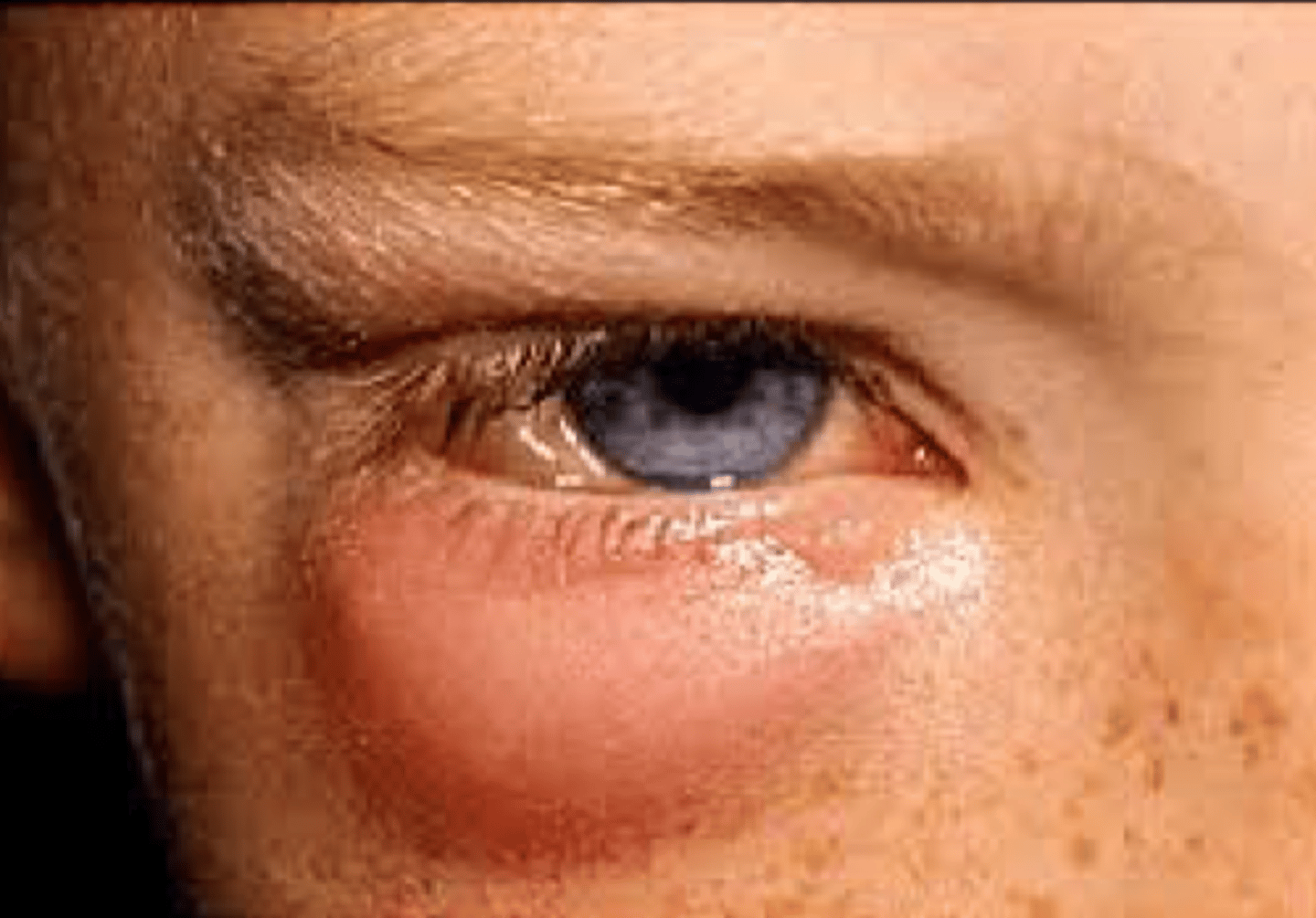 <p>What condition shown here must we consider with a hordeolum?</p>