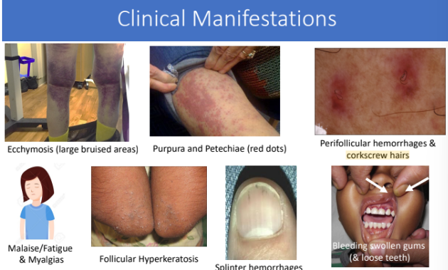 <ol><li><p>Ecchymosis (large bruised areas)</p></li><li><p>Purpura and Petechiae (red dots)</p></li><li><p>Perifollicular hemorrhages and corkscrew hairs </p></li><li><p>Malaise/fatigue &amp; myalgias</p></li><li><p>Follicular hyperkeratosis</p></li><li><p>Splinter hemorrhages</p></li><li><p>Bleeding swollen gums (loose teeth) </p></li></ol><p></p>