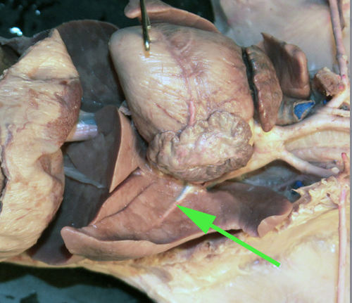<p><span>The vessel marked by the green arrow is a branch of a</span><br><span> <strong>pulmonary </strong>artery.</span></p>
