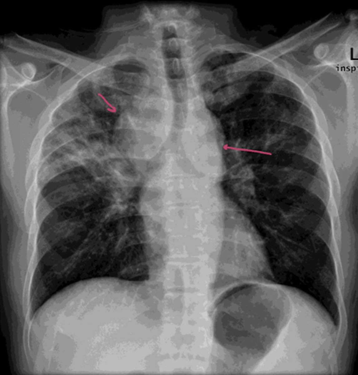 <p>African American female presents with cough, dyspnea, and a skin finding called erythema nodosum</p><p>exam: restrictive pattern with reduced lung volumes and reduced diffusion capacity on LFTs</p><p>What sign is present?</p>