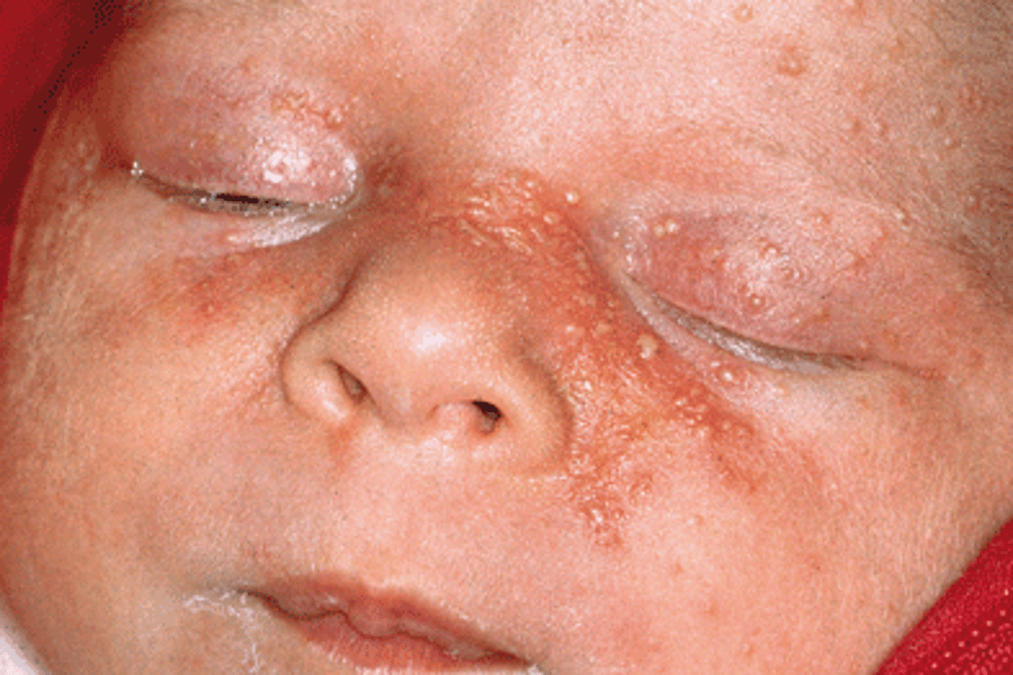 <p>often white, yellow or flesh colored. described as doughnut-shaped with an indentation in the center</p>