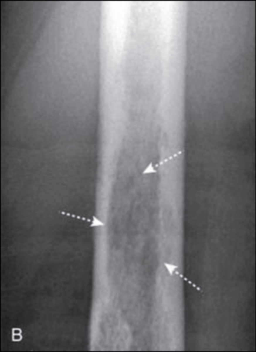<p>Accurately describe this pattern of bone destruction</p>