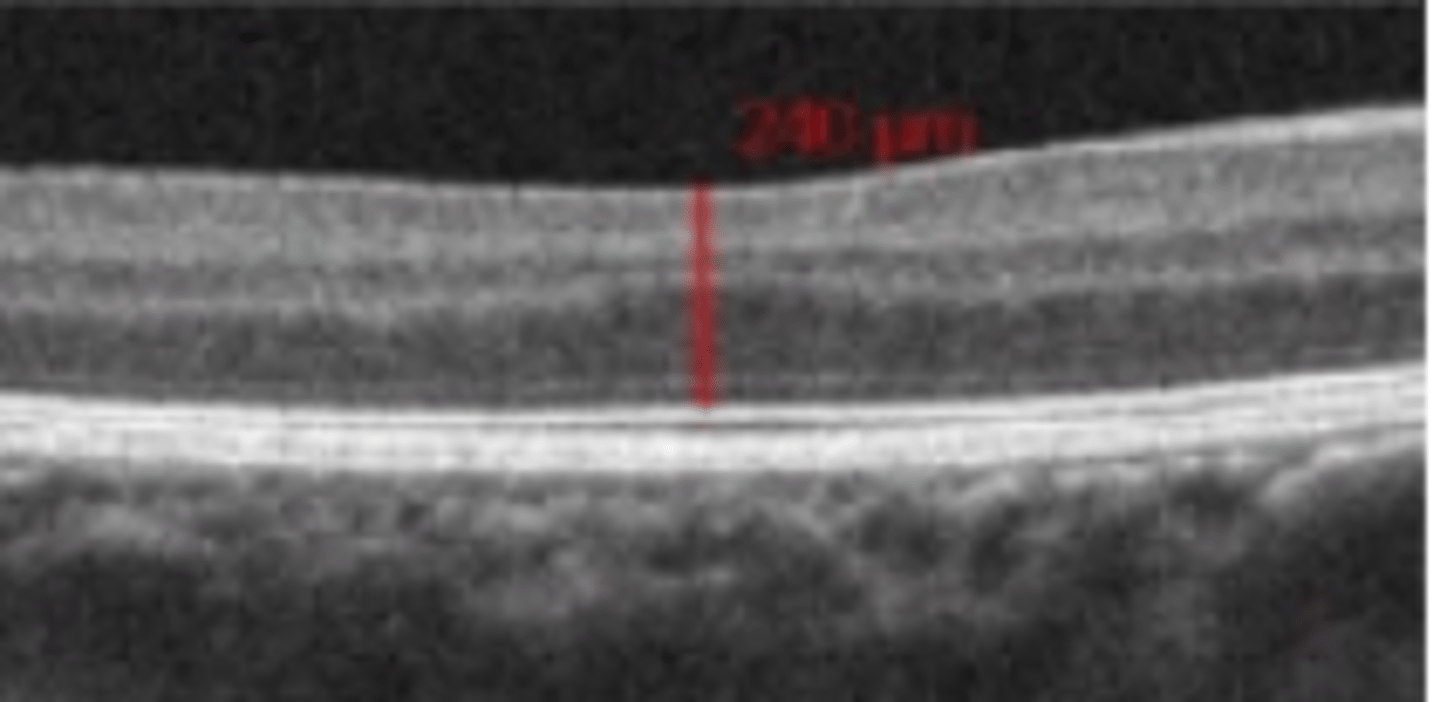<p>absence of the foveal pit. Is the biggest contributor to poor vision in both type I and type II albinism.</p>