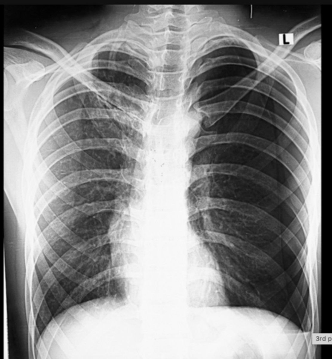 <p>What sign is present on this x-ray? What is the diagnosis based on this sign?</p>