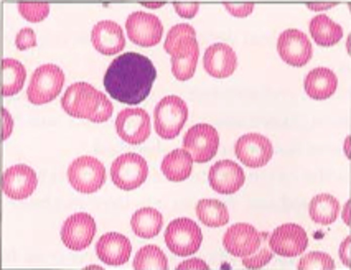 <p>condition in which the body does not have enough red blood cells due to lack of iron, which is a mineral essential for hemoglobin production</p>