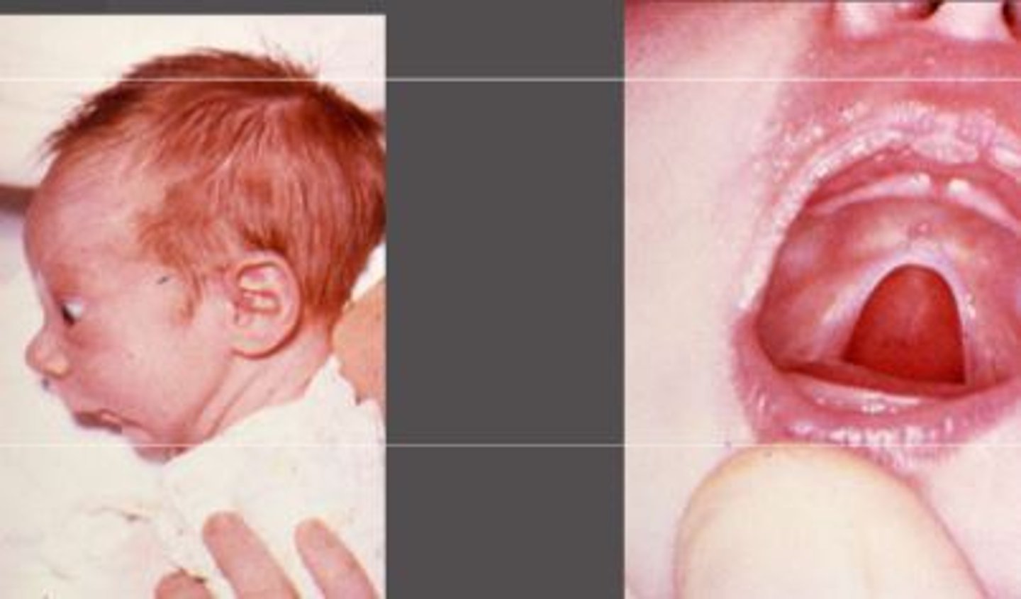 <p>Mandibular hypoplasia, glossoptosis, cleft soft palate. W/ FAS or Edwards.</p>
