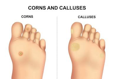 <p>both hyperkeratosis in the stratum corneum caused by friction and pressure; thickened skin.</p><p>differ in size, location, pain level: corns are smaller, more localized, often painful, round/oval with hard center.<br>callus are larger, more diffuse, usually less painful, usually flat and on WB areas. </p>
