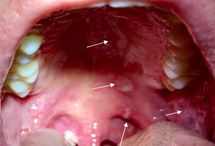 <p>What oral findings are common in Pemphigus Vulgaris?</p>