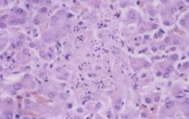 <p>Pink mass of protein with nuclear fragments, with intranuclear inclusion bodies outside the lesion</p><ul><li><p>Congealing of dying hepatocytes</p></li></ul><p></p>