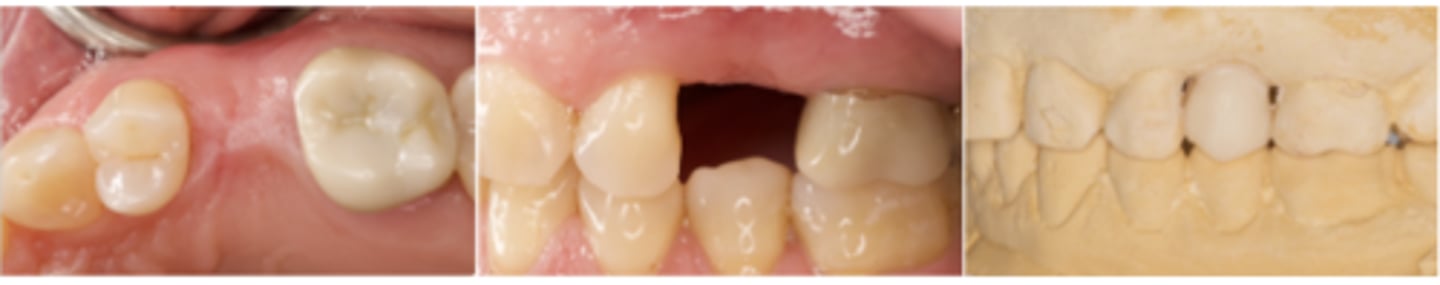 <p>What is the purpose that we need to start wax-up the tooth for dental implant treatment? (select one)</p><p>a. To decide implant position</p><p>b. To make final restoration</p><p>c. No answer text provided.</p><p>d. To make provisional restoration</p>