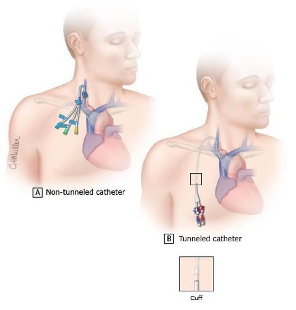 <p>Used for temporary access and can be placed in the subclavian, femoral, or internal jugular veins</p>