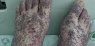 <p>larger than petechiae, smaller than ecchymoses</p>