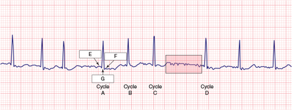 <p>Examine the region shaded in red between cycles C and D. It should be clear that there is extra electrical activity there, so which of the following seems the most plausible?</p><p></p><p>The extra waveforms indicate that the ventricles are depolarizing additional times between cycle C and cycle D.</p><p>The extra waveforms indicate that the atria are depolarizing additional times between cycle C and D.</p>