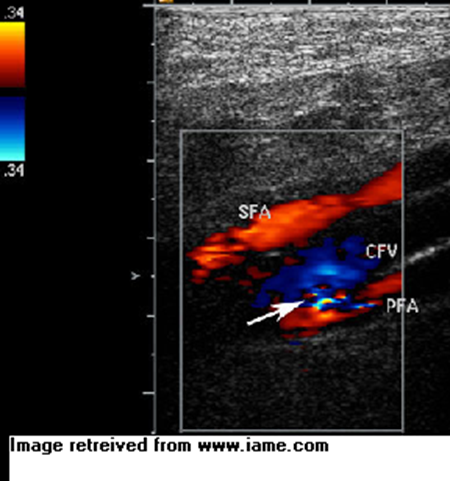 aliasing jet shown on the connection