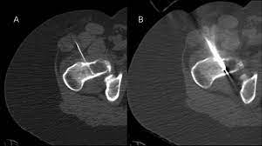 <p>What does this refer to</p><ul><li><p>Core needle bx</p><ul><li><p>From areas of bone scalloping or lysis</p></li></ul></li><li><p>Histology</p><ul><li><p>Blue-gray lobulated hyaline cartilage with scattered calcifications</p></li></ul></li></ul><p></p>