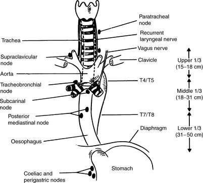 <p>Along entire length of esophagus draining into any adjacent draining nodal bed</p><p>Risk of <strong>skip mets</strong></p>
