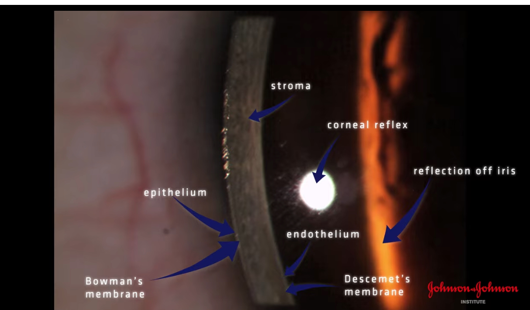 <p>The temporal side is the thickest part of the cornea so the layers differentiate more </p><p></p>