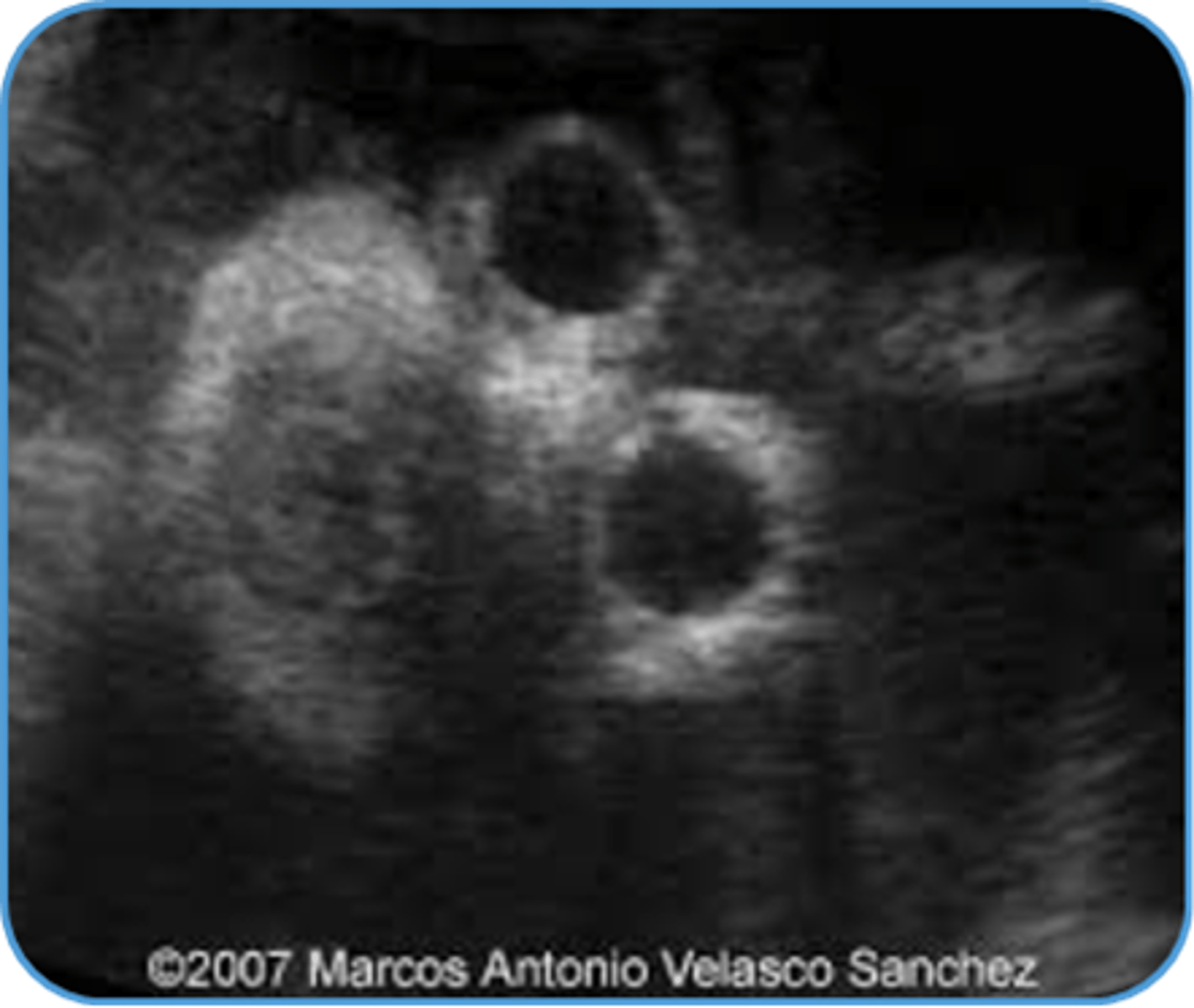 <p>Decreased spaced between eyes</p><p>Common with skull/brain anomalies &amp; syndromes</p>