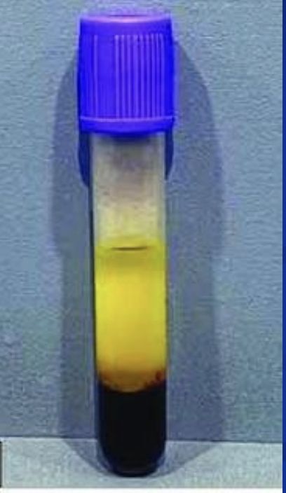 <ul><li><p>proportion of blood volume that is occupied by RBCs; assists in evaluating hydration status, anemia or polycythemia </p></li><li><p>norma female: 36-47% Normal male: 41-51%</p></li><li><p>increased in polycythemia, high altitudes, heavy smoking, chronic lung disease, congenital heart defects </p></li><li><p>decreased in anemia and hemodiltion </p></li><li><p>critical cut-off level is <25%</p><ul><li><p>case by case basis</p></li><li><p>may participate in essential ADLs with assistance </p></li></ul></li></ul><p></p>