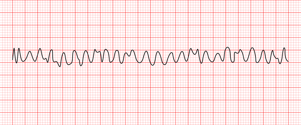 <ul><li><p>rate: 150-500 BPM</p></li><li><p>no identifiable waves</p></li><li><p>chaotic irregular deflections of varying amplitude</p></li></ul><p></p>