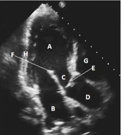 <p>In this image, which portion of the cardiac phase is it in?</p>