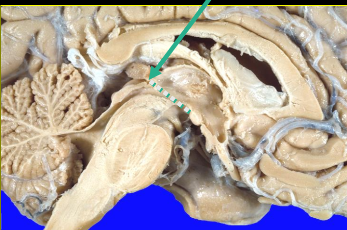 <p>behind mamillary body to posterior commisure </p>